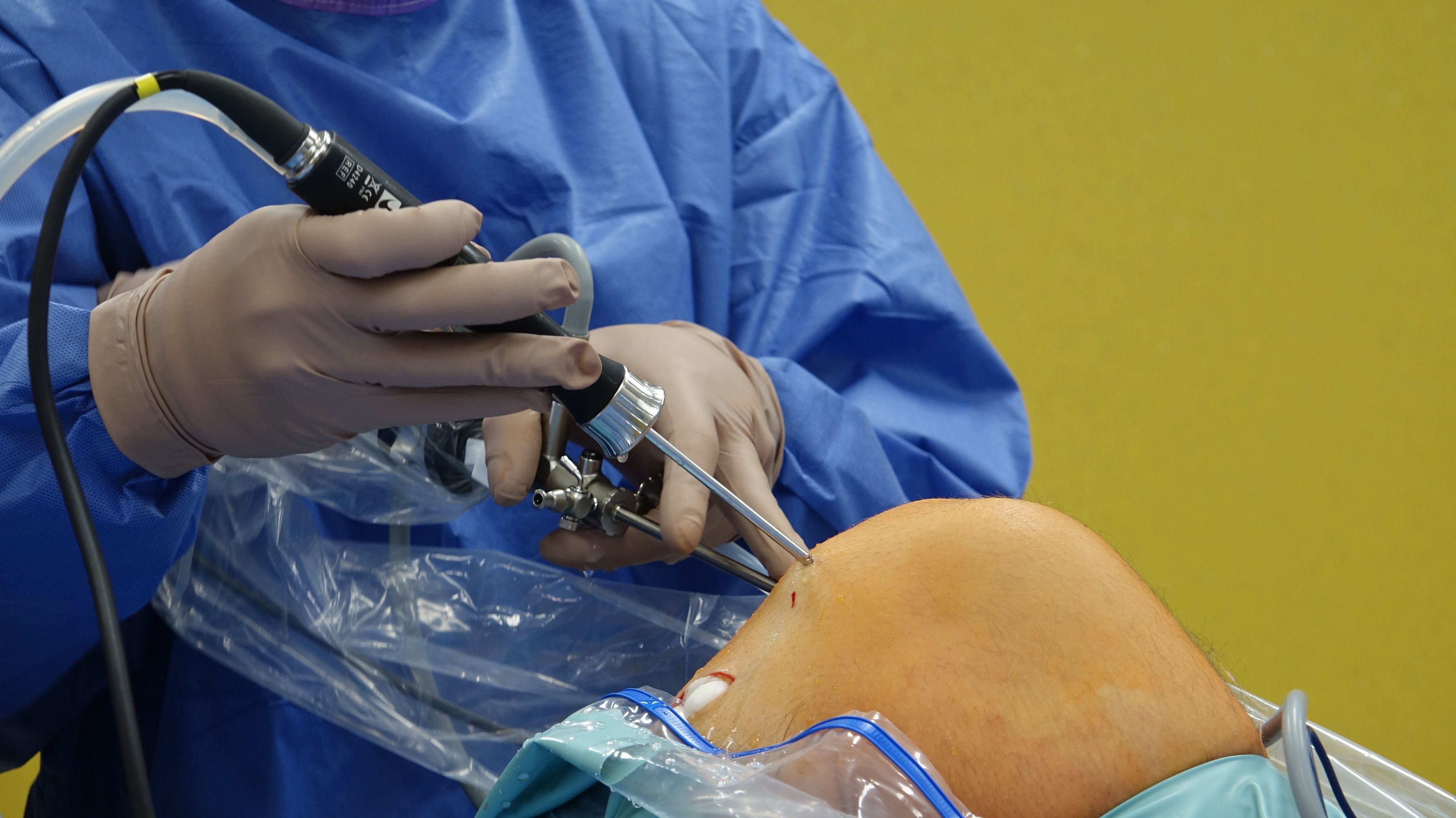 Cirugía artroscópica de rodilla: cuándo está indicada y cuándo no