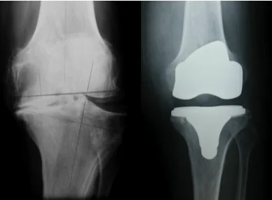 Radiografía de rodilla